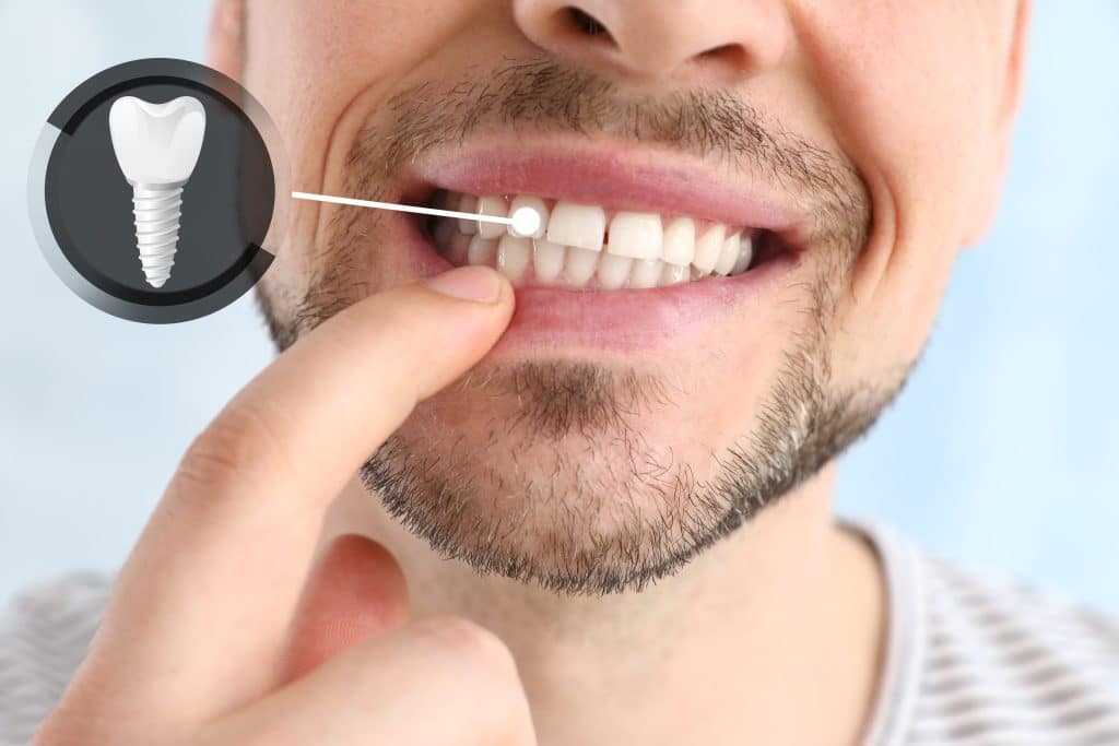 Dental Implants Near Me