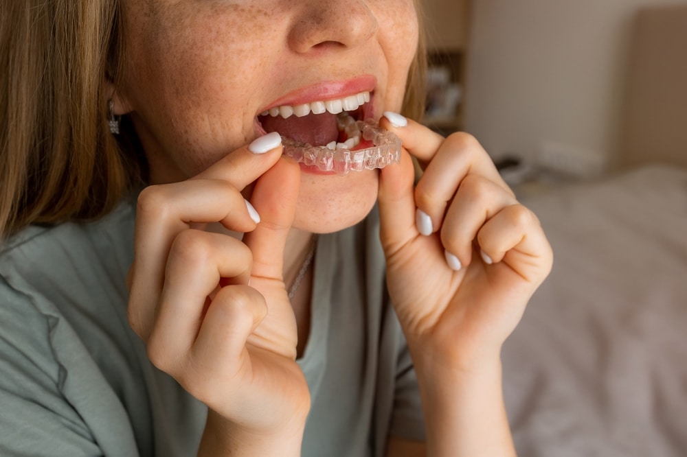 clear aligners mountain view